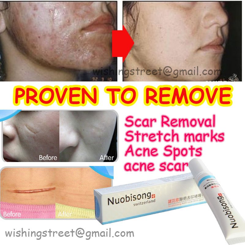 Nuobisong Face Care Acne Scar Removal Cream Acne Spots Skin Care Treatment Whitening Face Cream 6323